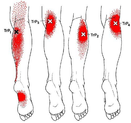 trigger-points-plantar-fascitis Diagram showing plantar fasciitis trigger points in the gastrocnemius muscle, mimicking pain in the arch of foot.